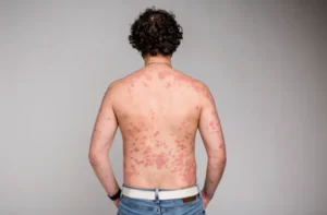 Ultimate Guide to Psoriasis and Eczema Together : Reversing Extreme Skin Dysfunction