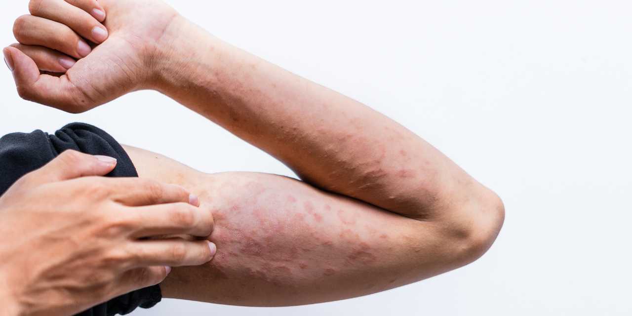 Ultimate Guide to Psoriasis and Eczema Together : Reversing Extreme Skin Dysfunction